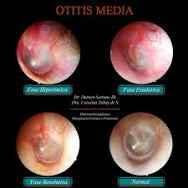 otitis Media con membrana timpánica inflamada a punto de reventarse/// Otitis Media with an inflamed tympanic menbrane about to burst