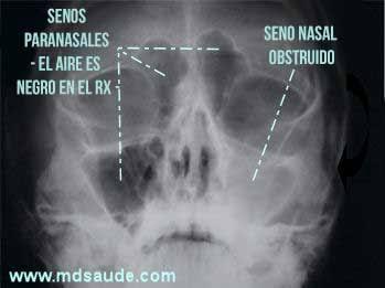 La sinusitis es una infección de los senos nasales,con síntomas de dolor en la región frontal y maxilar,congestión nasal y mucosidad amarilla y verde.///sinusitis is an infection of the sinuses,with symptoms of pain in the frontal and maxillary regions,nasal congestion and yellow and green mucus.