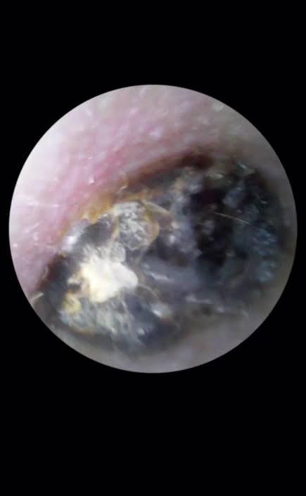 Infección de hongos en oídos///fungal infections of the ears