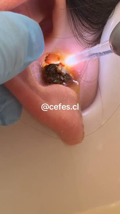 Tapón de cerilla en oido///earwax buildup